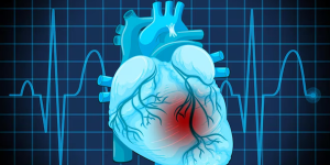Tetralogy of Fallot (TOF)